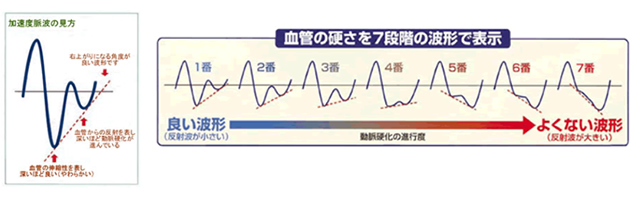 血管の硬さを7段階の波形で表示